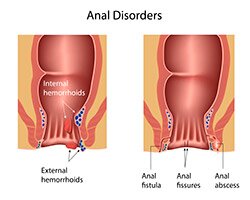 fistula problemas anal cirugia guadalajara mexico