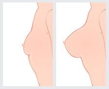 costo de implantes de seno en guadalajara mexico