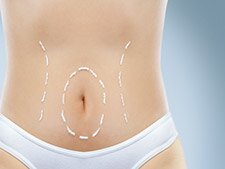 lipo abdomen lipolaser liposcuccion lipolisis guadalajara mexico