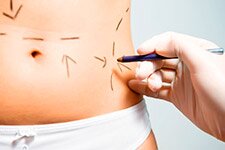 Abdominoplastia y miniabdomino