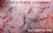 telagiectasias arañas vasculares laser guadalajara