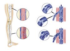 varices piernas cirugia laser guadalajara mexico